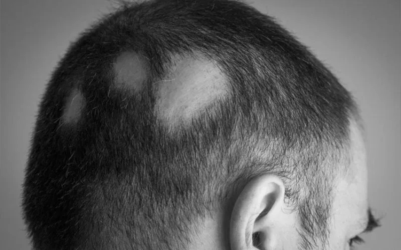 Alopecia Areata