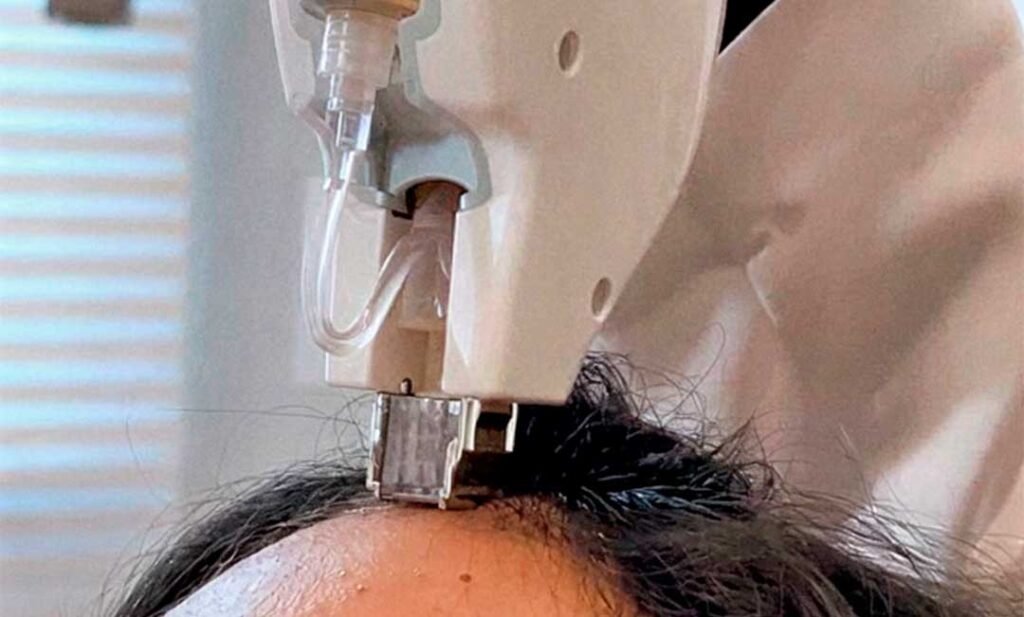Eletroporação-(Mesoterapia-Capilar)